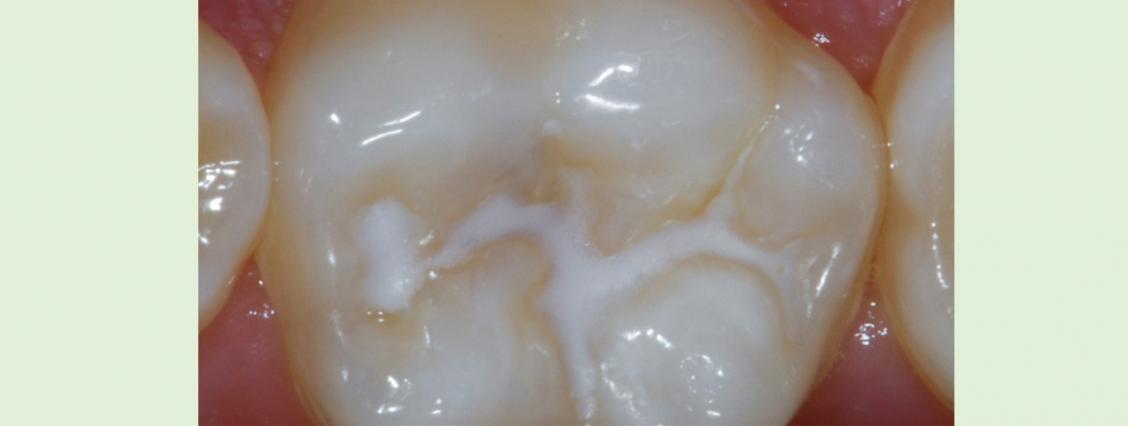 Ein Zahn mit Fissurenversiegelung